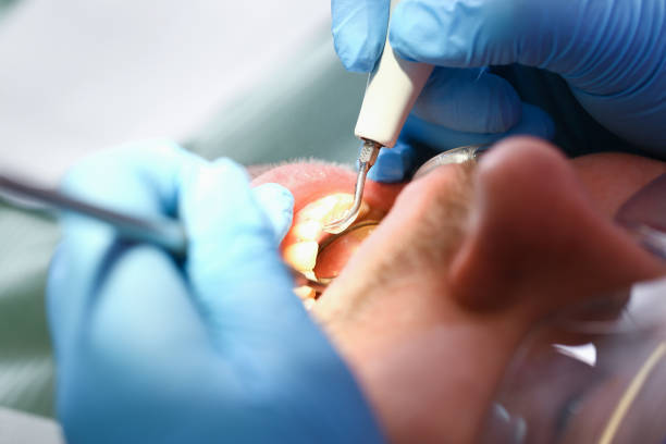 Best Emergency Dental Care for Broken or Chipped Teeth in Cedarville, OH